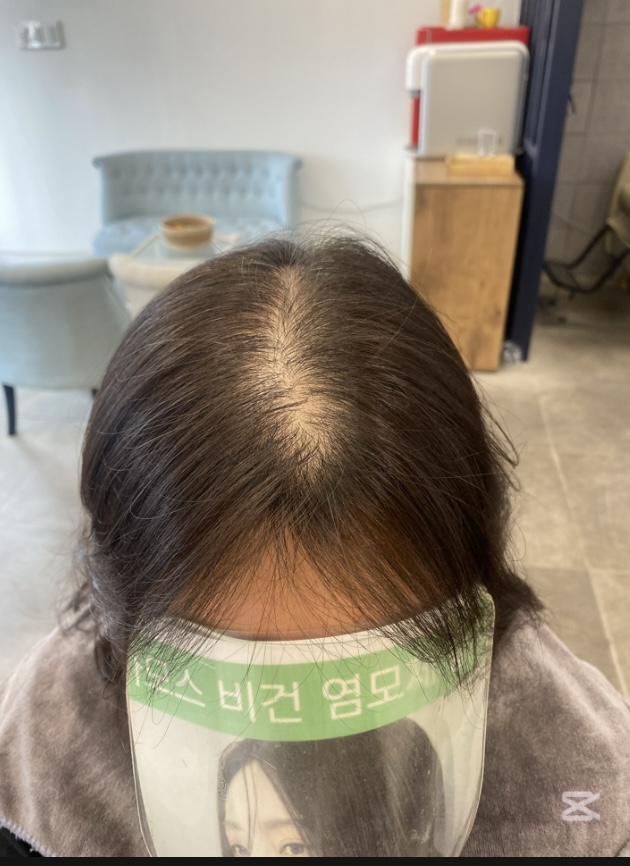 시술 전 — 모류교정펌